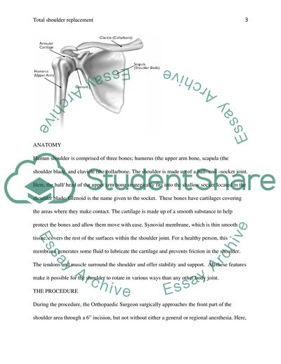 Total Shoulder Replacement