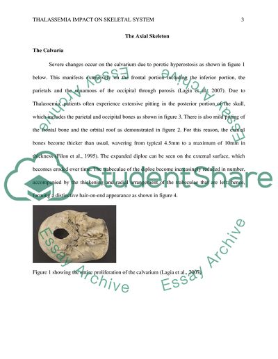 How Does Thalassemia Affect the Skeletal System