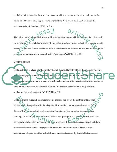 Normal Colon, Crohns Disease and Ulcerative Colitis