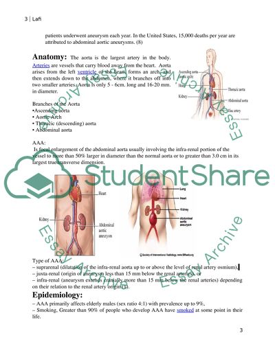 Abdominal Aortic Aneurysm
