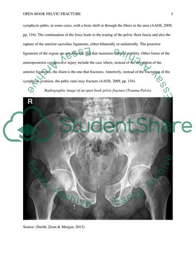 Open-Book Pelvic Fracture