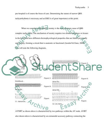 Pre-hospital Emergency Treatment for Narrow Complex Tachycardia