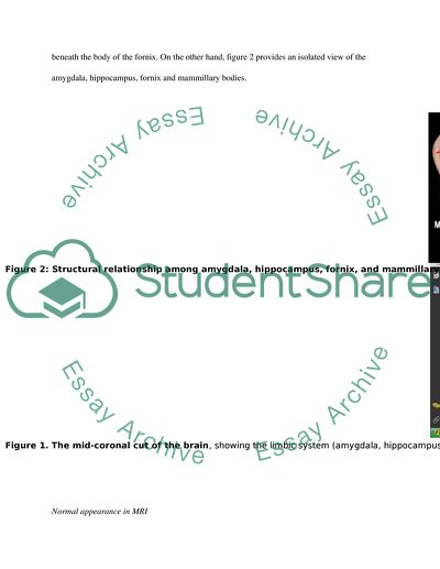 The Anatomy and Normal MR Appearance of the Hippocampus