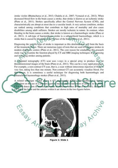 dissertation on stroke