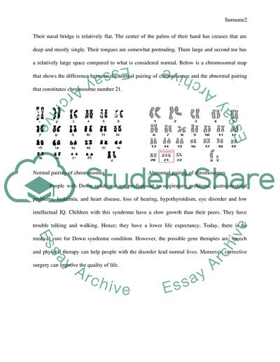 Down Syndrome Condition